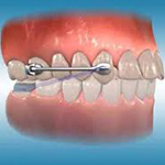 palatal expander