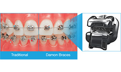 self-ligating braces