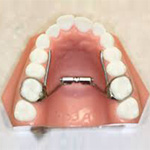 palatal expander