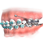 palatal expander