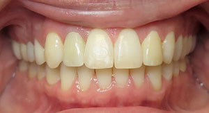 missing lateral incisors after