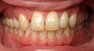 missing lateral incisors before
