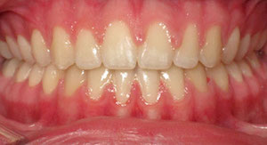 spacing of teeth after